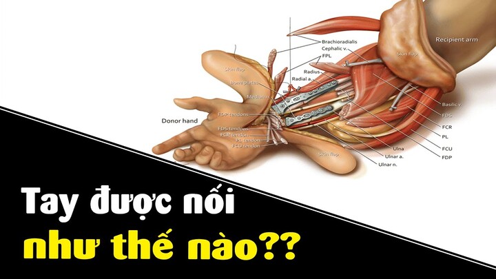 Cánh tay đứt rời được nối lại như thế nào??