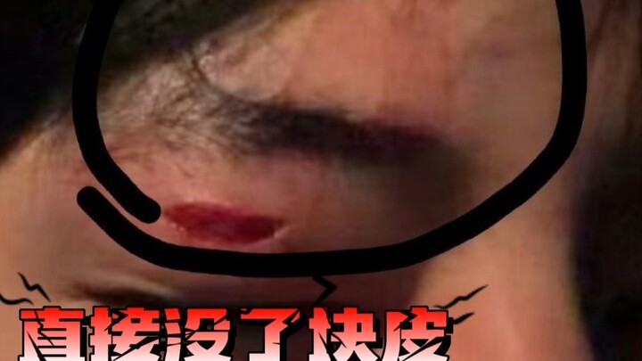 #الممثل في الدراما القصيرة وانغ نيان يصاب أثناء التصوير.. الجرح كبير هكذا، والممثل المنافس لم يُخفِ 