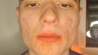 Before and After Cadaveric Changes