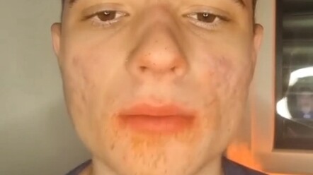 Before and After Cadaveric Changes