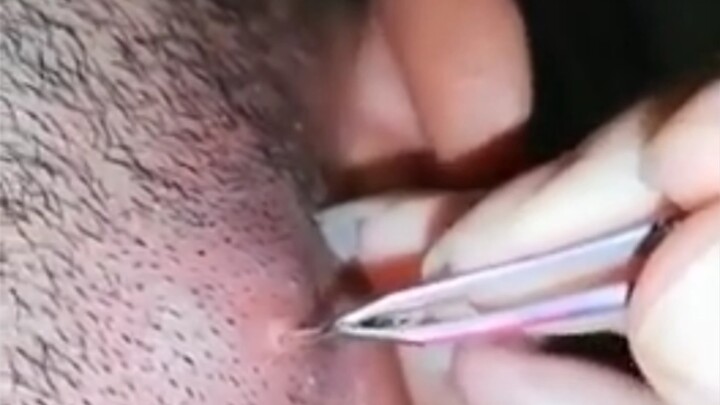 แมลงตัวเดียวทำให้หนุ่มปวดบวมที่หลังหู