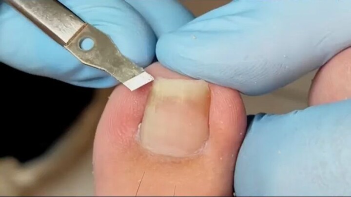 Repairing Toenails Tutorial_R