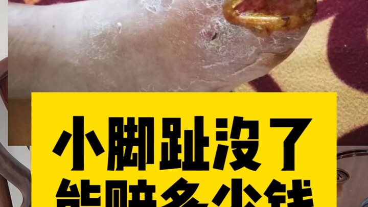 How much compensation for losing a little toe?