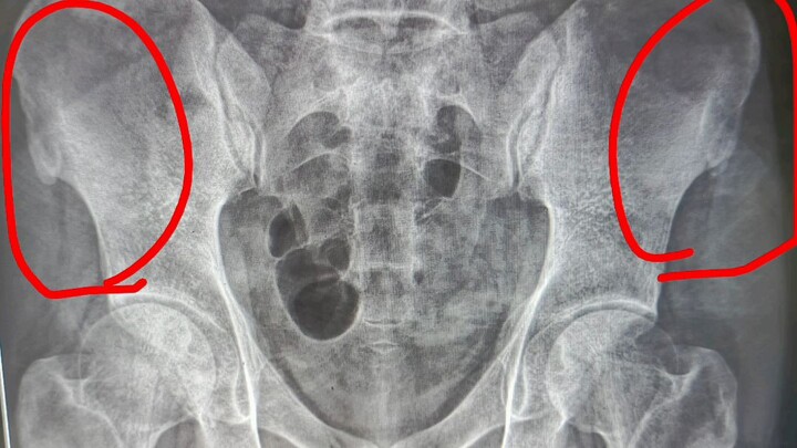 Bilateral Iliac Crest Changes on X-ray: Understanding Normal Apophyseal Ossification