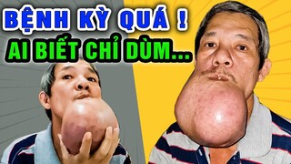Khối u lạ xuất hiện khủng trên mặt, người đàn ông này liên hệ Guufood chỉ để xin điều này… - Guufood