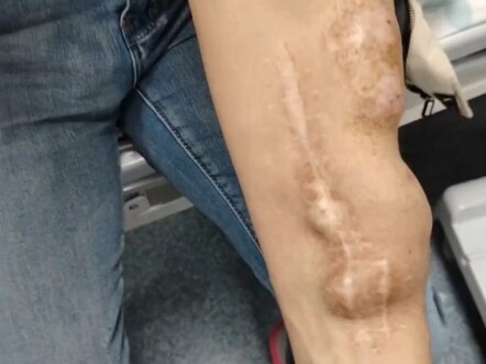 คนที่ไม่ได้ปัสสาวะเลย ไตทั้งสองข้างก็เสียไปแล้ว