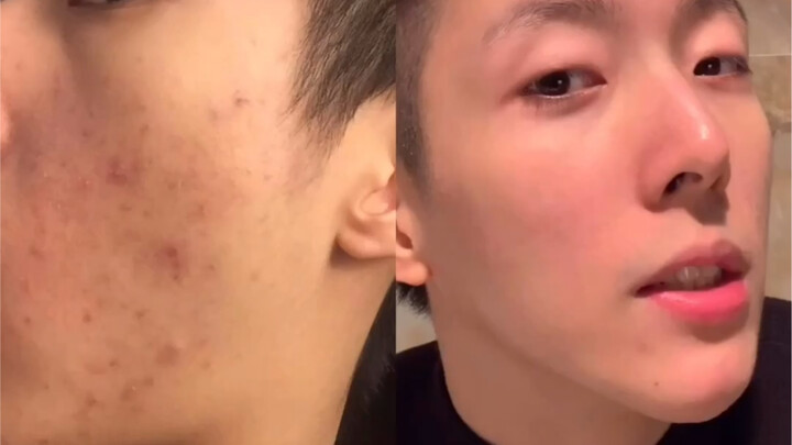 How Did I Cure My Bad Skin?