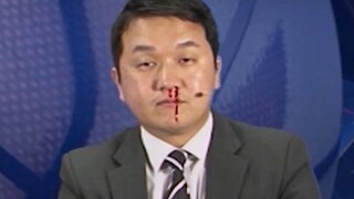 Famous scene! He continued to commentate during a live broadcast with a nosebleed, shocking everyone