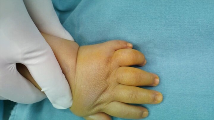 Bayi berjari 24 membuat dokter langsung berkomentar sangat rapi, sang ibu: Saat baru lahir pun tak a