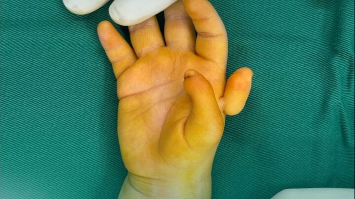 จะจัดการกับภาวะนิ้วเกินแบบพิเศษยังไงดี? แค่ตัดนิ้วออกเพียงอย่างเดียวคงไม่พอแน่นอน