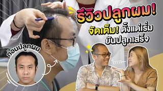 รีวิวปลูกผม | ตั้งแต่เริ่มจนเสร็จ