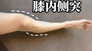 为什么膝内侧越来越突出！我们该怎样矫正？（自救方案分享）
