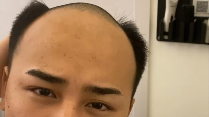 At 21, hairline has receded badly—how can it be fixed? How do you choose a wig to cover it up? Or go