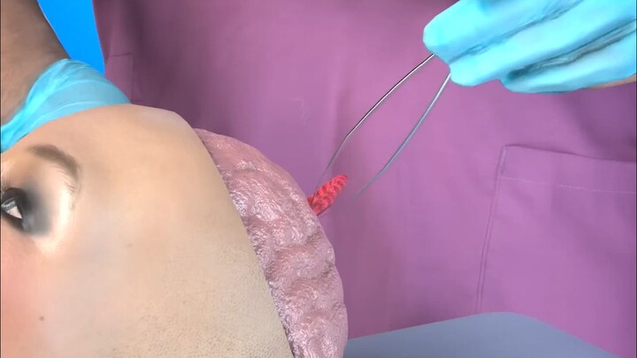 A seven-centimeter worm was found in a woman’s brain.