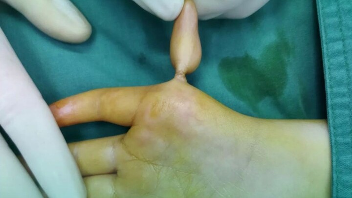 Yêu cầu của phụ huynh “rất đơn giản”: mong con dùng tay cầm bút để viết và ăn cơm.