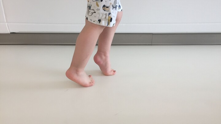 Toe Walking in Children