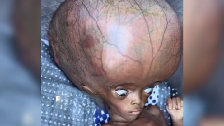 Born With an Enlarged Head: Is It Water on the Brain? Causes & Solutions