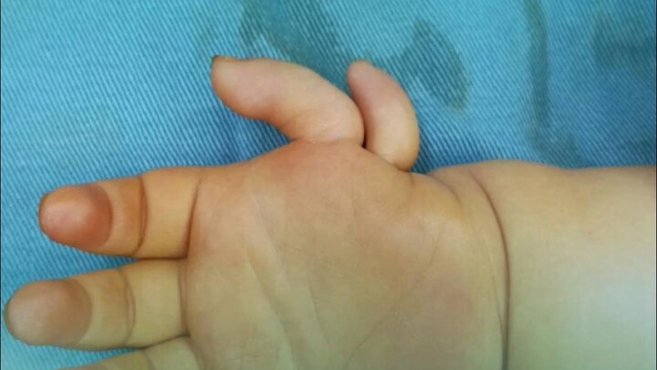 妈妈：你手指动一下乖乖，“漂浮拇”从无到有建立功能