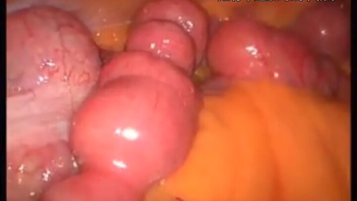 الأمعاء الدقيقة تتململ بهدوء~~~