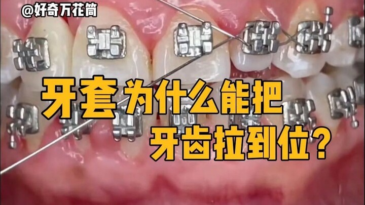 Why can braces move teeth into the right position? #SciencePopularization #StressRelief #Orthodontic