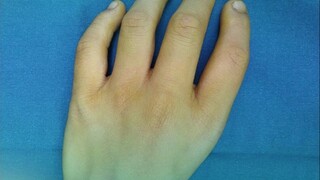 Anak yang lahir tanpa ibu jari, "mengganti pohon dengan bunga," memindahkan jari telunjuk ke posisi 