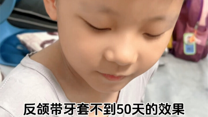 ขอขอบคุณชาวเน็ตที่เคยเตือนผมไว้เมื่อครั้งก่อนอีกครั้ง ผลลัพธ์ของพี่ชายที่จัดฟันเพื่อรักษาภาวะขากรรไก