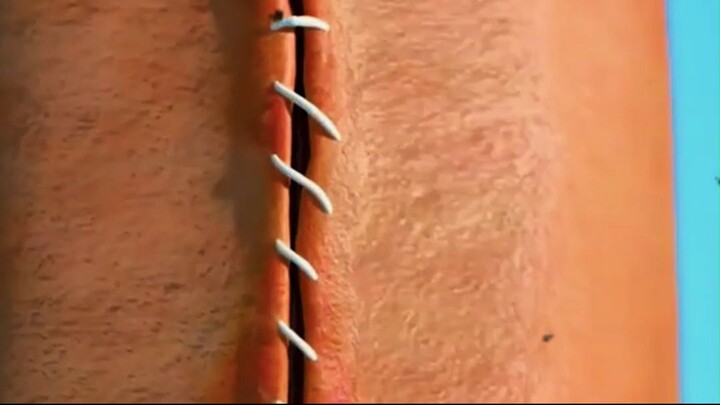 The Hidden Science Behind Medical Stitches!
