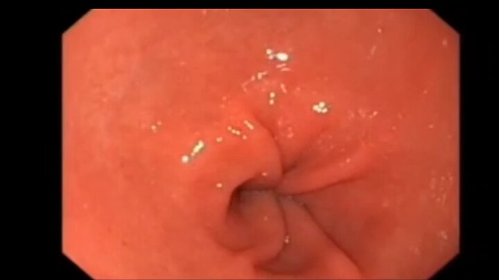 Seeing the peristaltic waves of the gastric antrum under gastroscopy—so this is what it looks like!