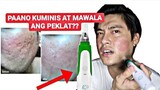 PAANO KUMINIS?! | PAANO MAWALA ANG MGA PEKLAT | DERMAPEN EXPERIENCE | 2020 REVIEW