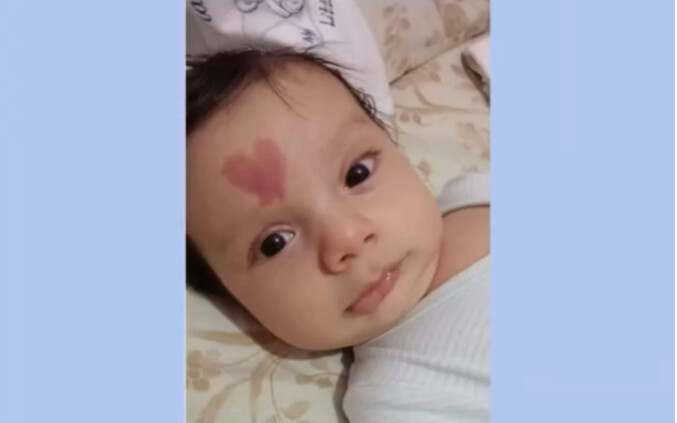 What kinds of birthmarks have you seen?