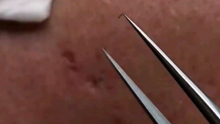 Pimple removal