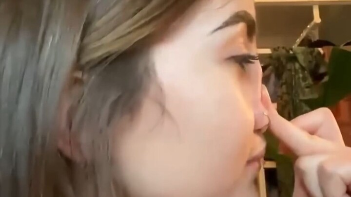 A girl was born without nasal cartilage, yet grew a perfect nose shape!