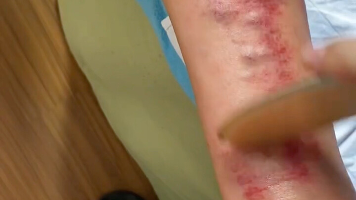 تنشيط مسار التامور