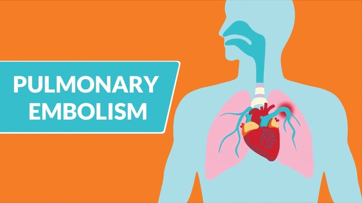 Pulmonary Embolism