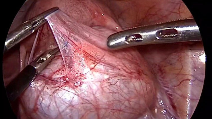 Oviduct Cyst as Big as a Duck Egg