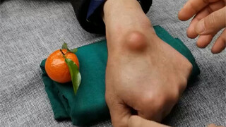Kill ganglion cyst instantly