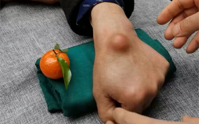 秒杀腱鞘囊肿
