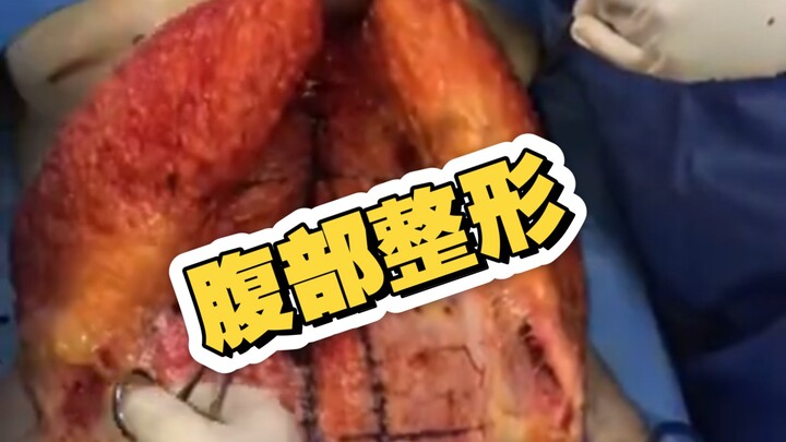 What Does an Abdominoplasty Procedure Involve? (Not for Medical Non-Professionals)