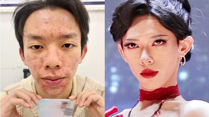 A Boy with Acne Over Ten Years