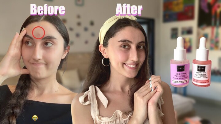 How I Got Rid of My Acne in a Week | Honest Review SCARLETT Acne Serum