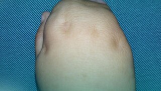 Xiaobao's fingers were completely fused together; two surgeries gave him back his "five fingers."