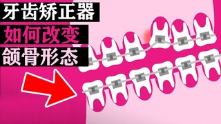 Penjelasan singkat 2 menit: Prinsip kerja kawat gigi (alat ortodontik), betapa cerdasnya desainnya