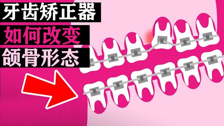 2-Minute Science: How Braces (Orthodontic Appliances) Work and How Ingeniously They're Designed