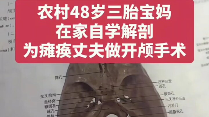 [Chủng Người TV] Bà mẹ siêu nhân thực hiện phẫu thuật mở hộp sọ cho chồng, đứa trẻ người Hoa đã có t