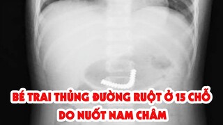 Cắt, nối ruột cho 2 bé trai nuốt 38 viên nam châm - PLO