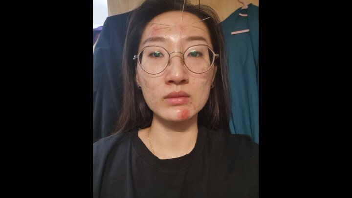 Immersive Acupuncture: A PhD Student in Acupuncture Self-Rescues After a Chemical Peel Allergy — Pro