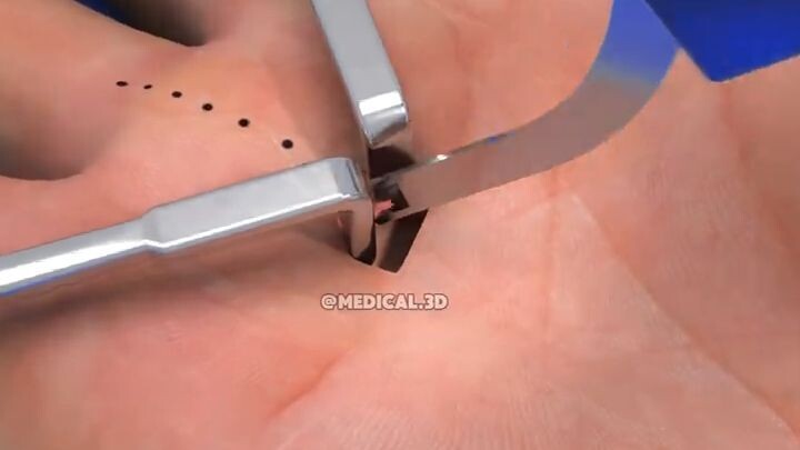 Trigger Finger Release Surgery (3D Animation)