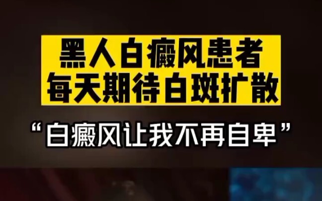 Black Man with Vitiligo Shouts: “I’m About to Become a Rich Person!”