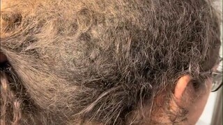 It took 4 hairdressers 10 hours to deal with the messy and tangled hair, and also cured the woman's 