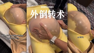 透过模型来看扶正胎位的「外倒转术」